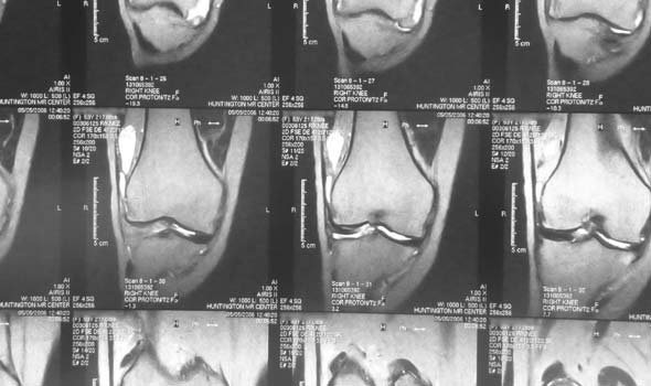MRI scan of osteoarthritic knee